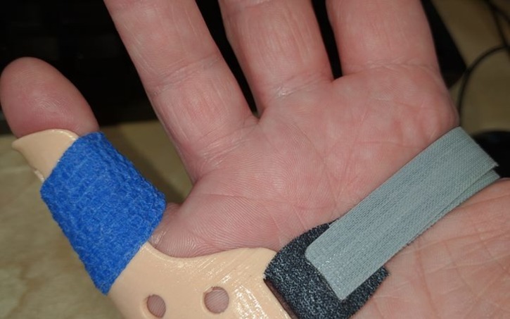 3d Design Pinky Finger Splint (right Hand) - Tinkercad